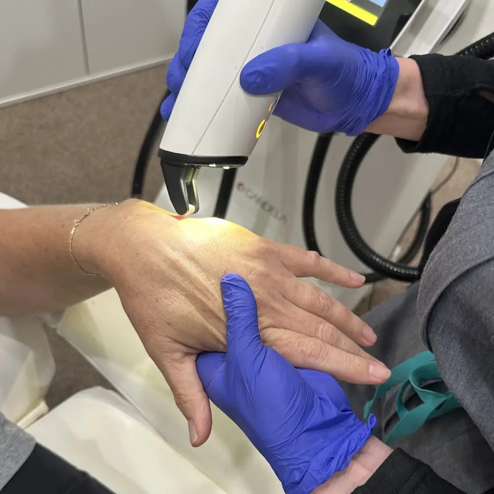 Medical professional wearing blue gloves using a handheld laser device to treat a patient's hand in a clinical setting.