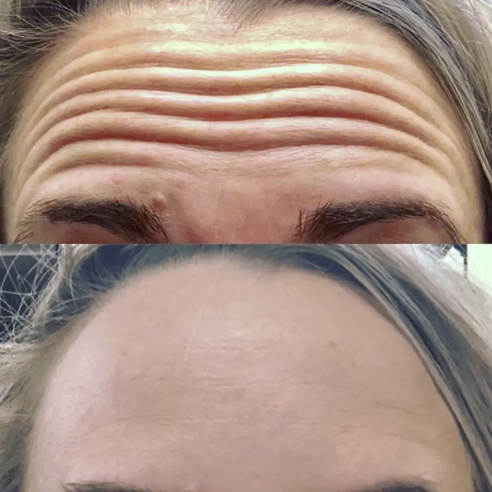Before and after comparison showing forehead wrinkles in the top image and smoother skin in the bottom image after treatment.