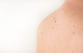 Close up detail of the bare skin on a man back with scattered moles and freckles. Checking benign moles. Sun effect on skin. Birthmarks on skin