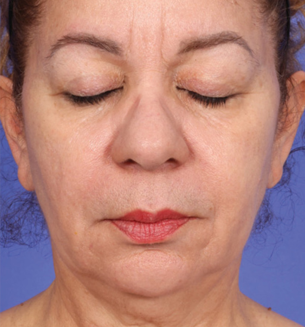 After 1 treatment of XERS photo