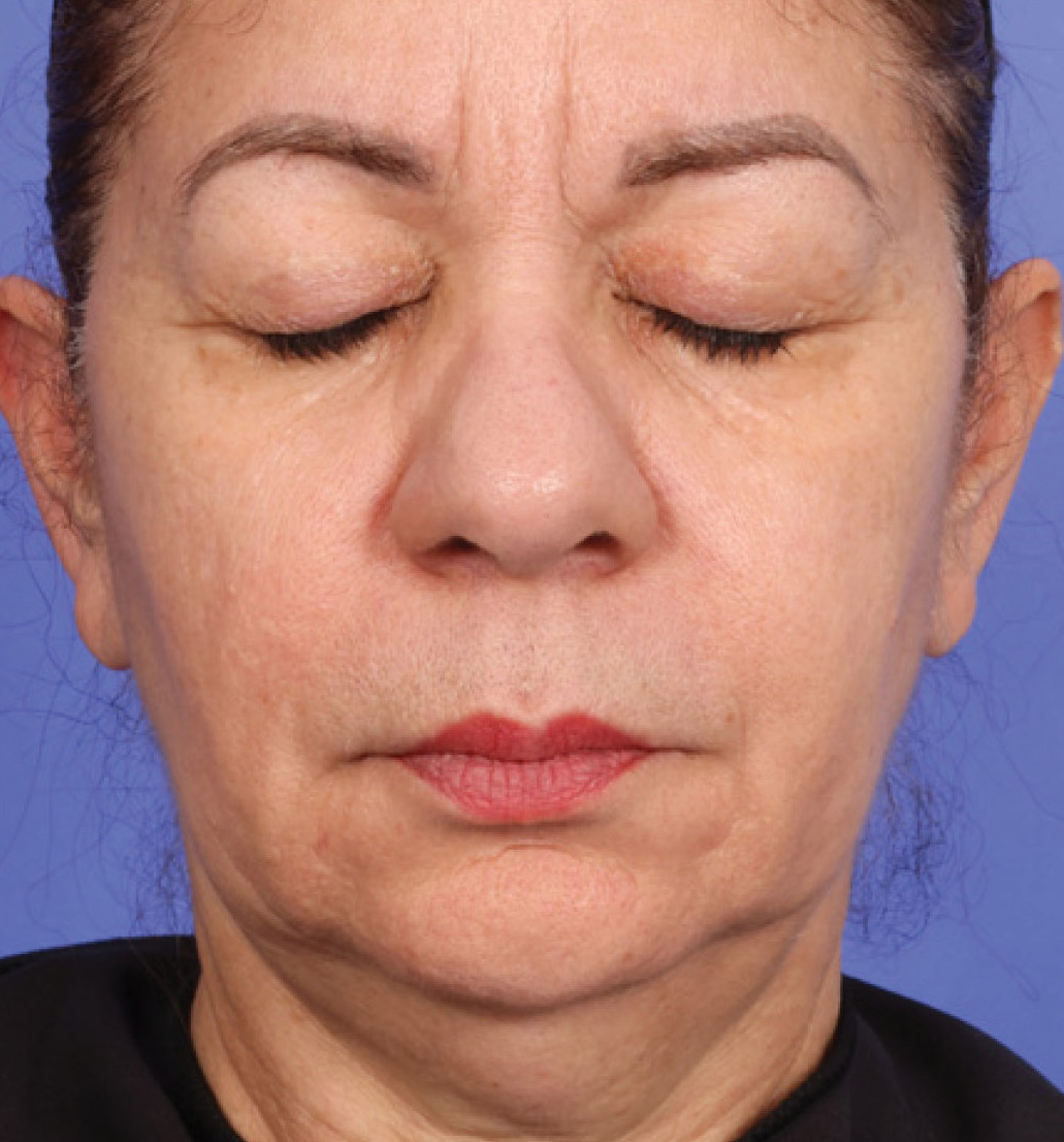 before 1 treatment of XERS photo
