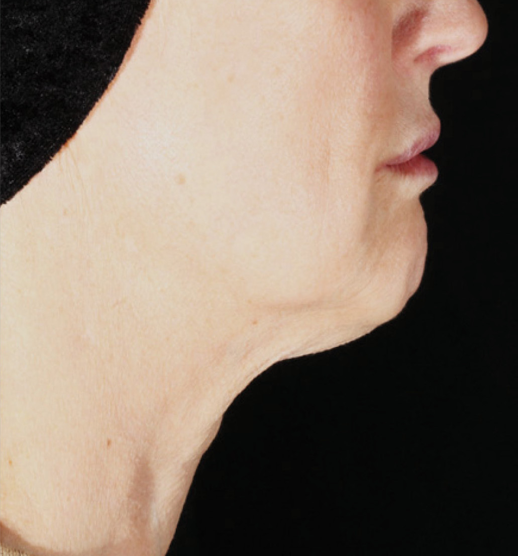 After 1 treatment of XERS photo