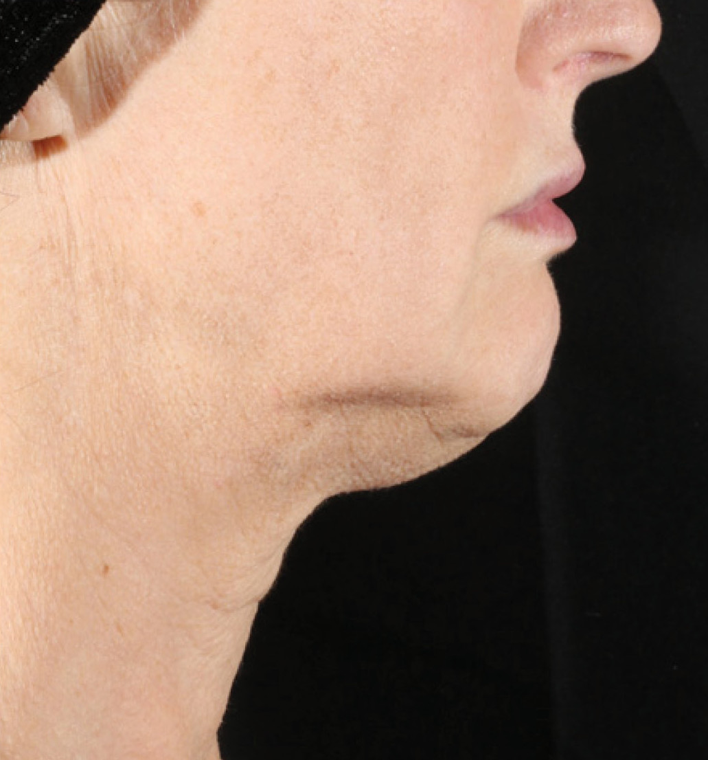 before 1 treatment of XERS photo