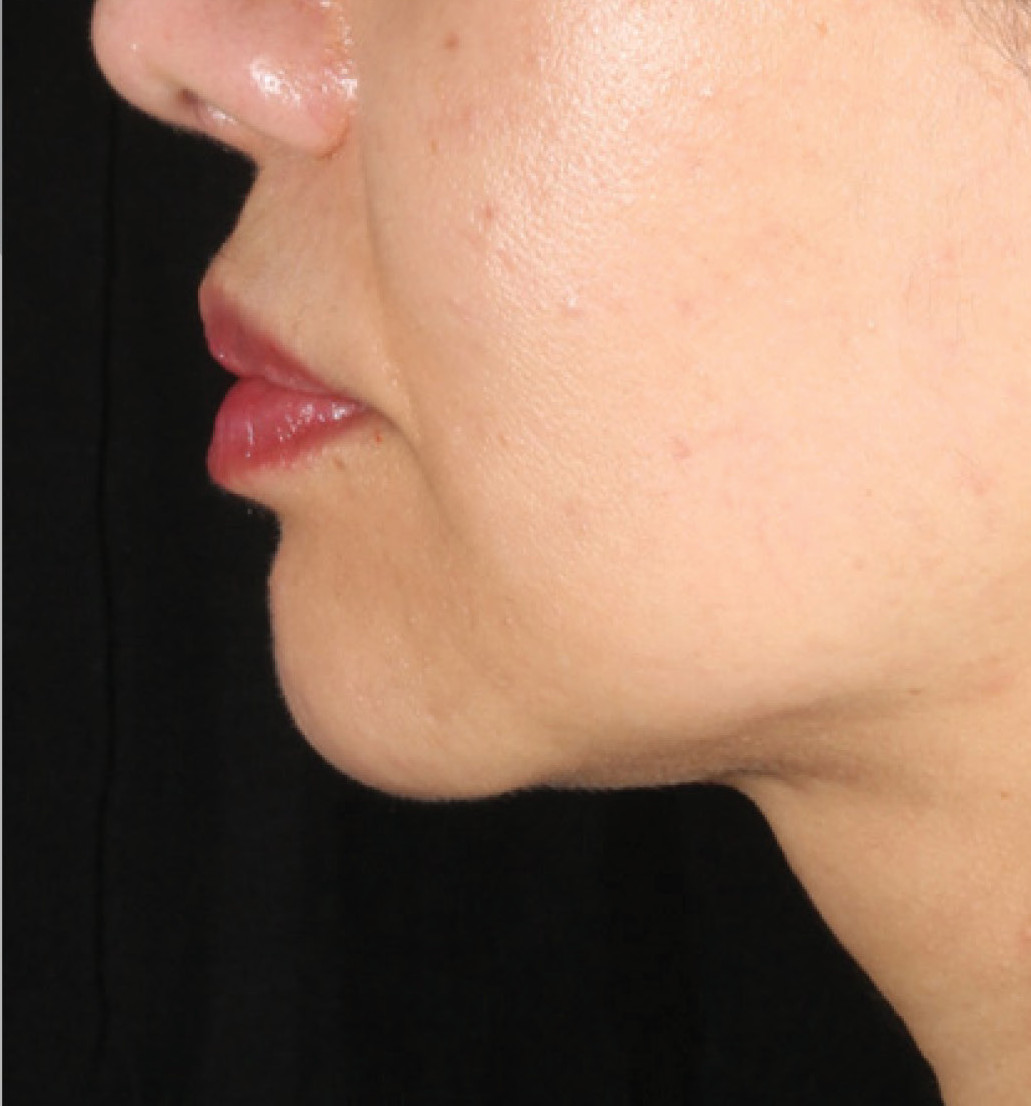 After 1 treatment of XERS photo