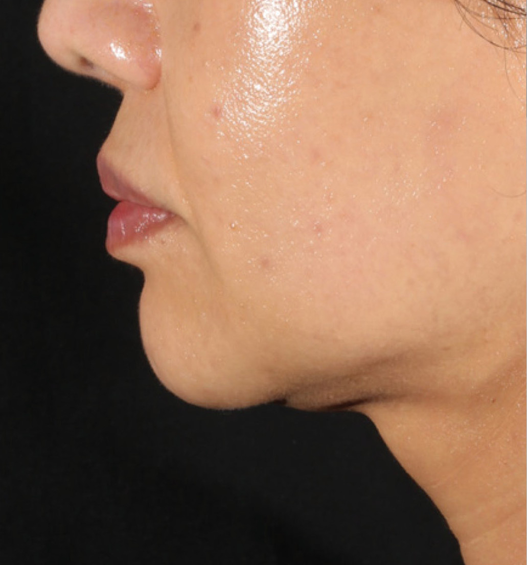 before 1 treatment of XERS photo