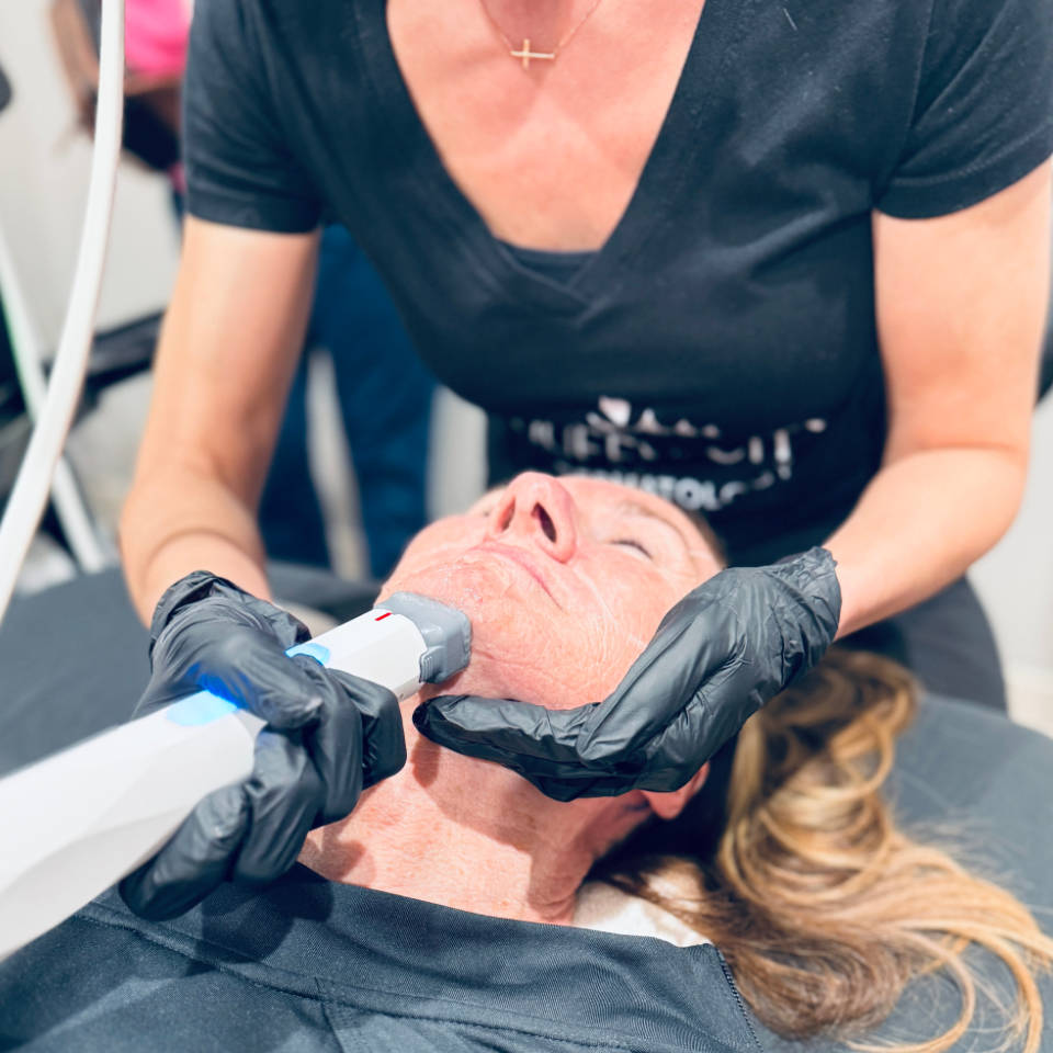 XERF Radiofrequency Skin Tightening procedure